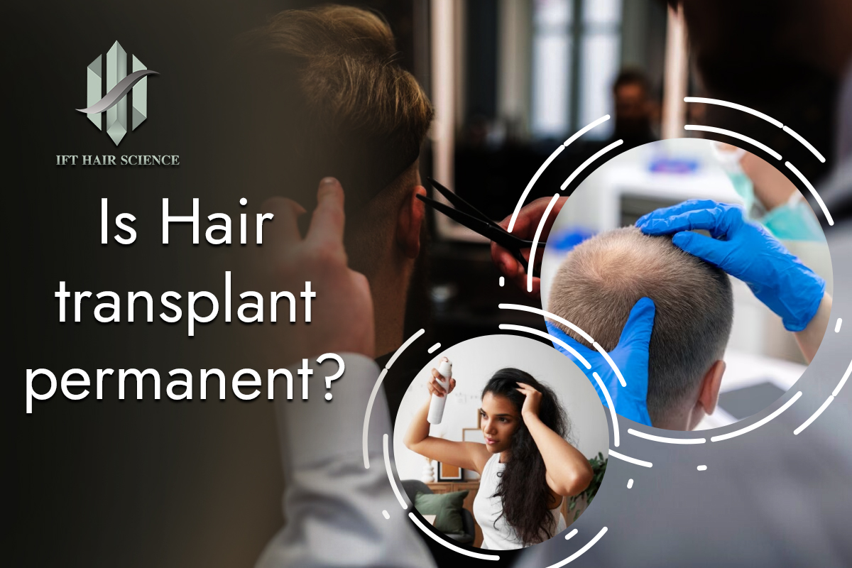 Is hair transplant permanent