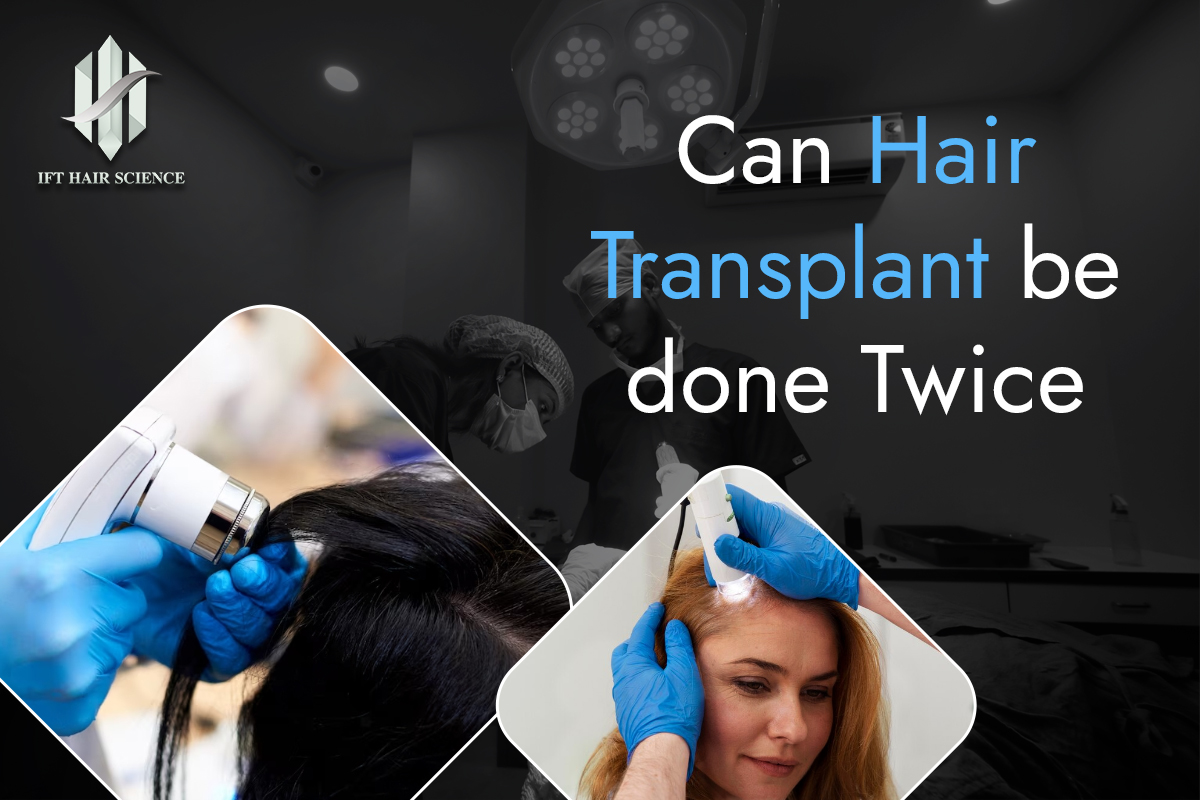 Hair transplant can be done twice
