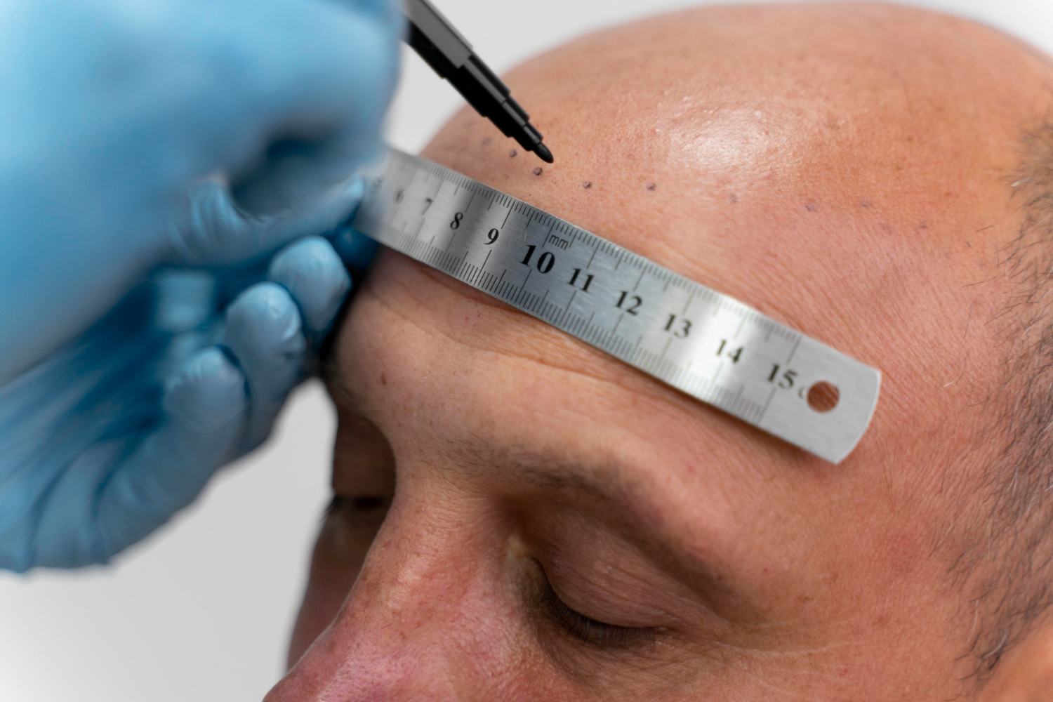 10 Benefits of Choosing the Interlocking FUE Technique for Hair Restoration