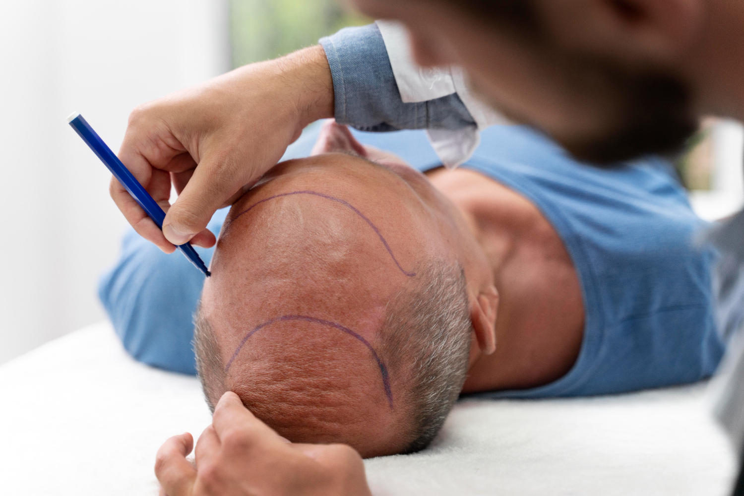 Post-Hair Transplant Care: Essential Tips for Fast Recovery 