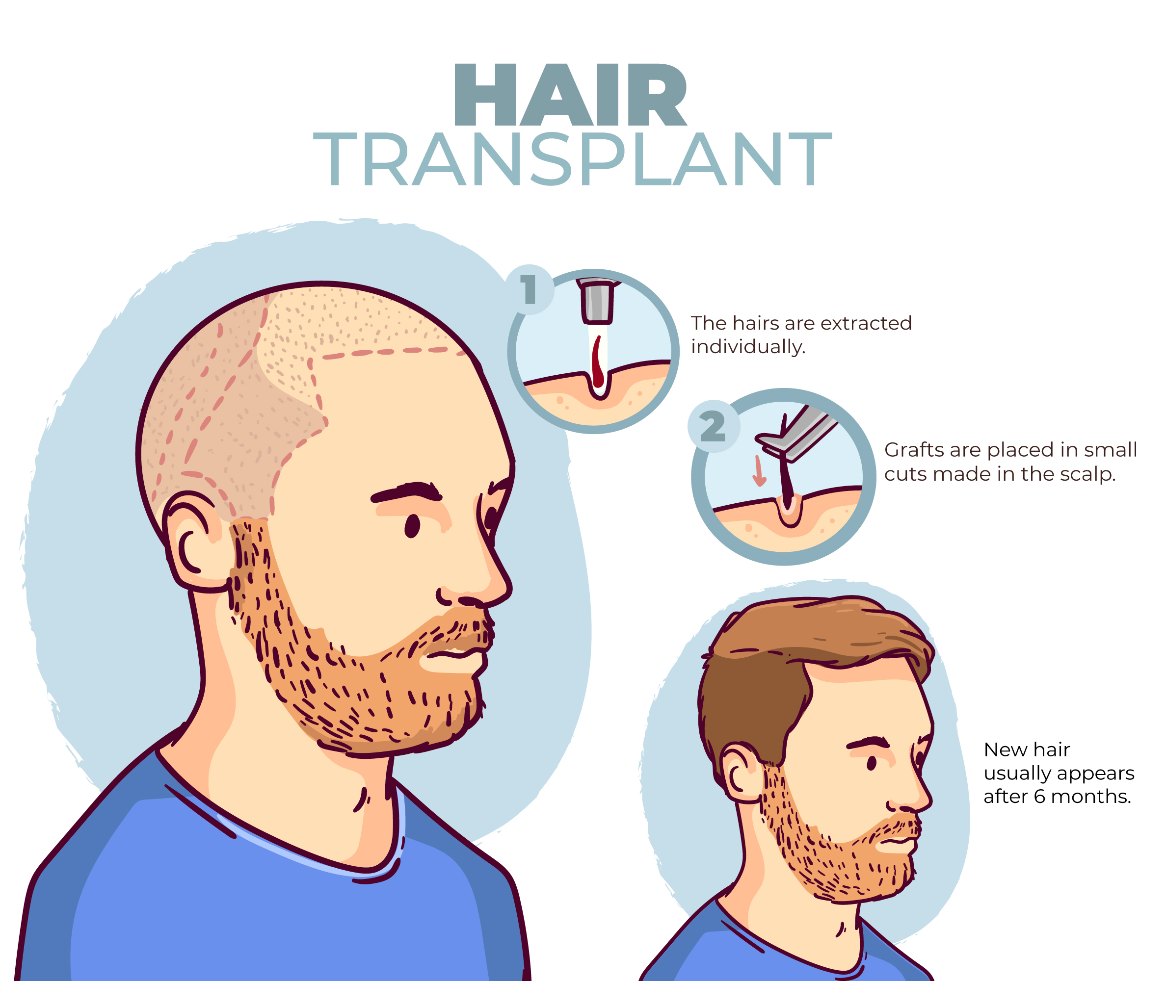 Why Hair Transplant is the Most Effective Solution for Baldness