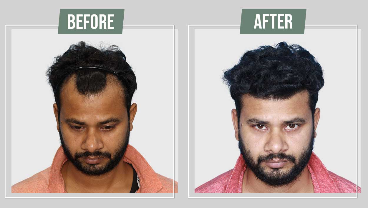 Understanding the Long-Term Benefits of Hair Transplants