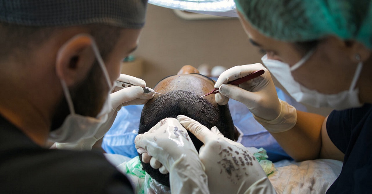 What is the Most Effective Hair Transplant Treatment?