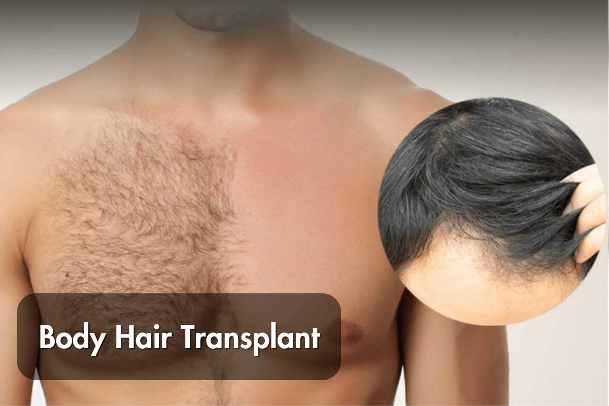 Natural-Looking Hair Transplants in Jaipur: Boost Confidence with IFT's Body Hair Transplant Expertise and Personalized Care