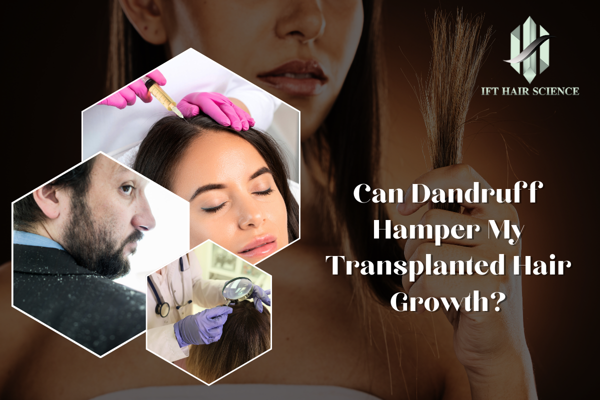 Can Dandruff Hamper My Transplanted Hair Growth