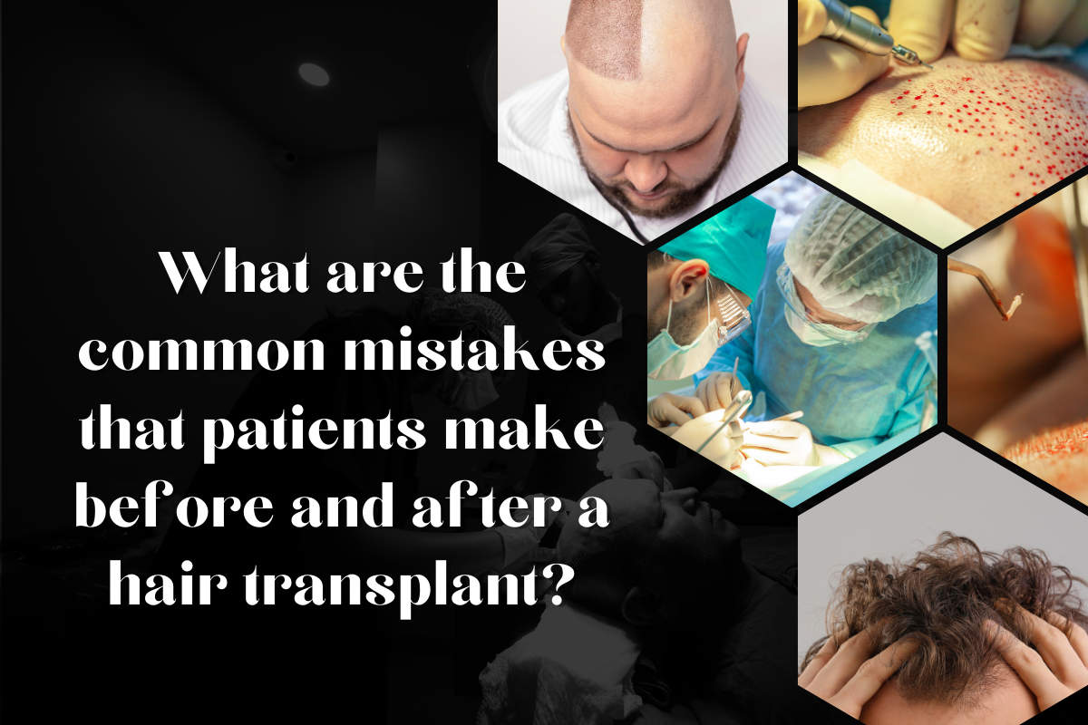 What Are The Common Mistakes That Patients Make Before And After A Hair Transplant