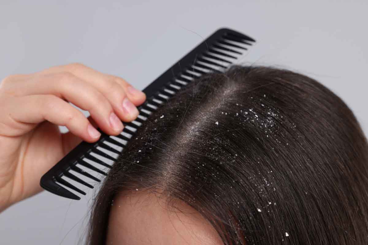 Preventing Hair Loss Caused by Dandruff: Expert Diagnosis and Treatment Strategies With IFT Hair Science