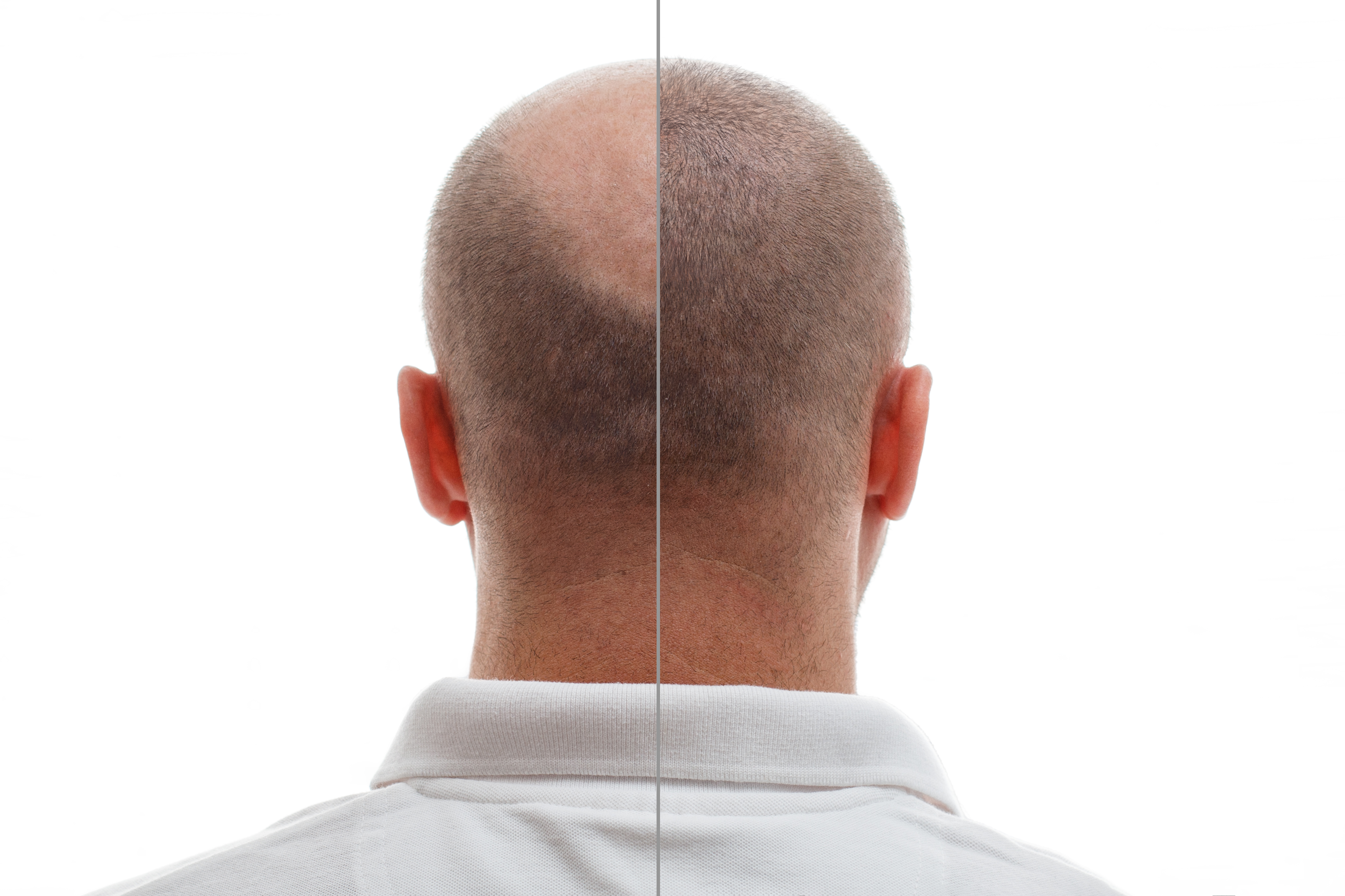 Why Hair Loss Happens and How a Hair Transplant Can Help