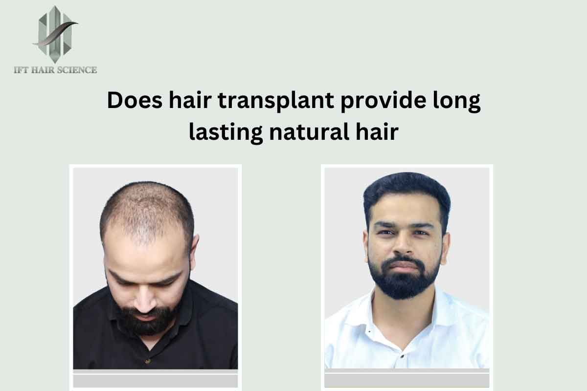 Does Hair Transplant Provide Long-Lasting Natural Hair?