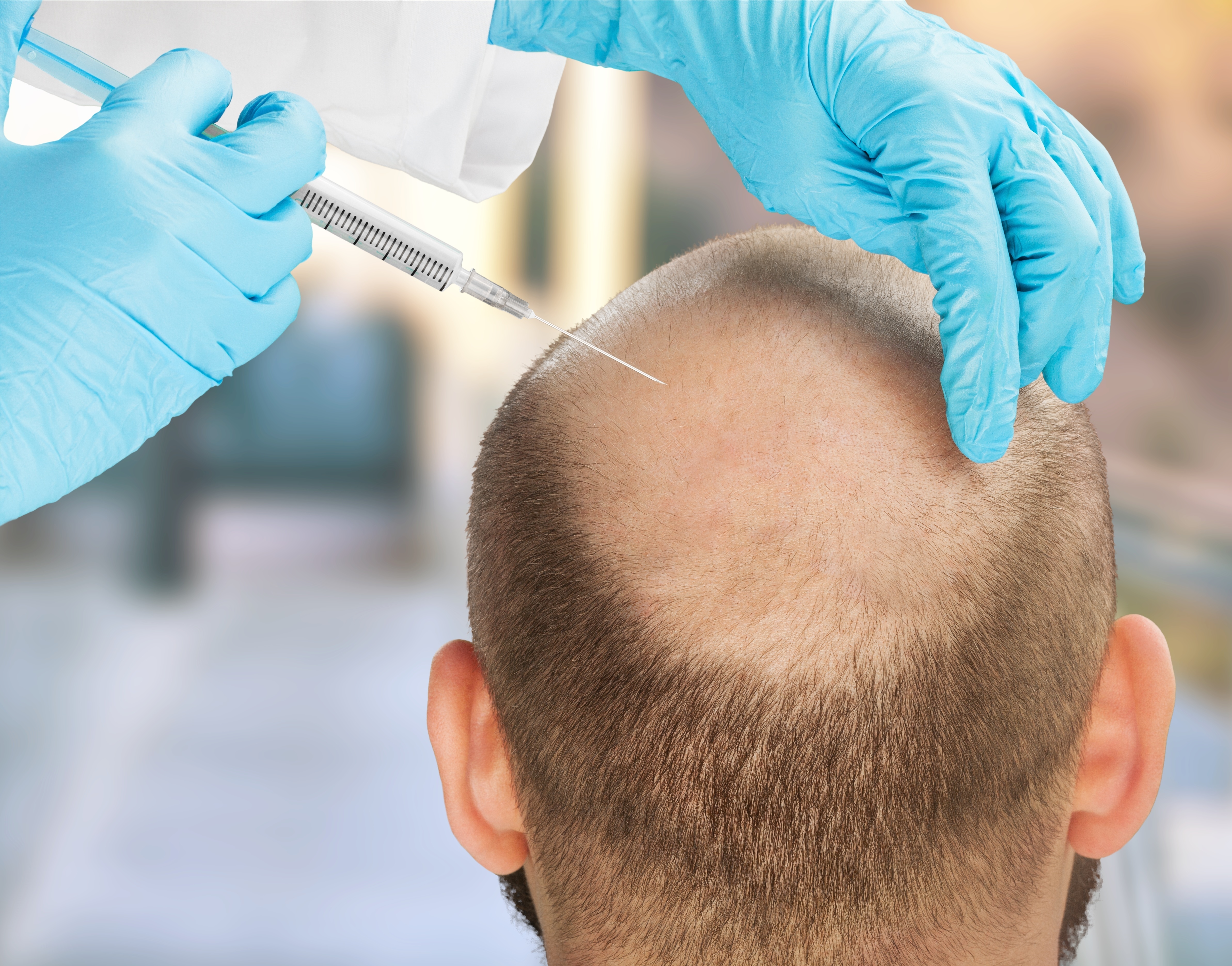 How Long Does It Take to See Results After a Hair Transplant?