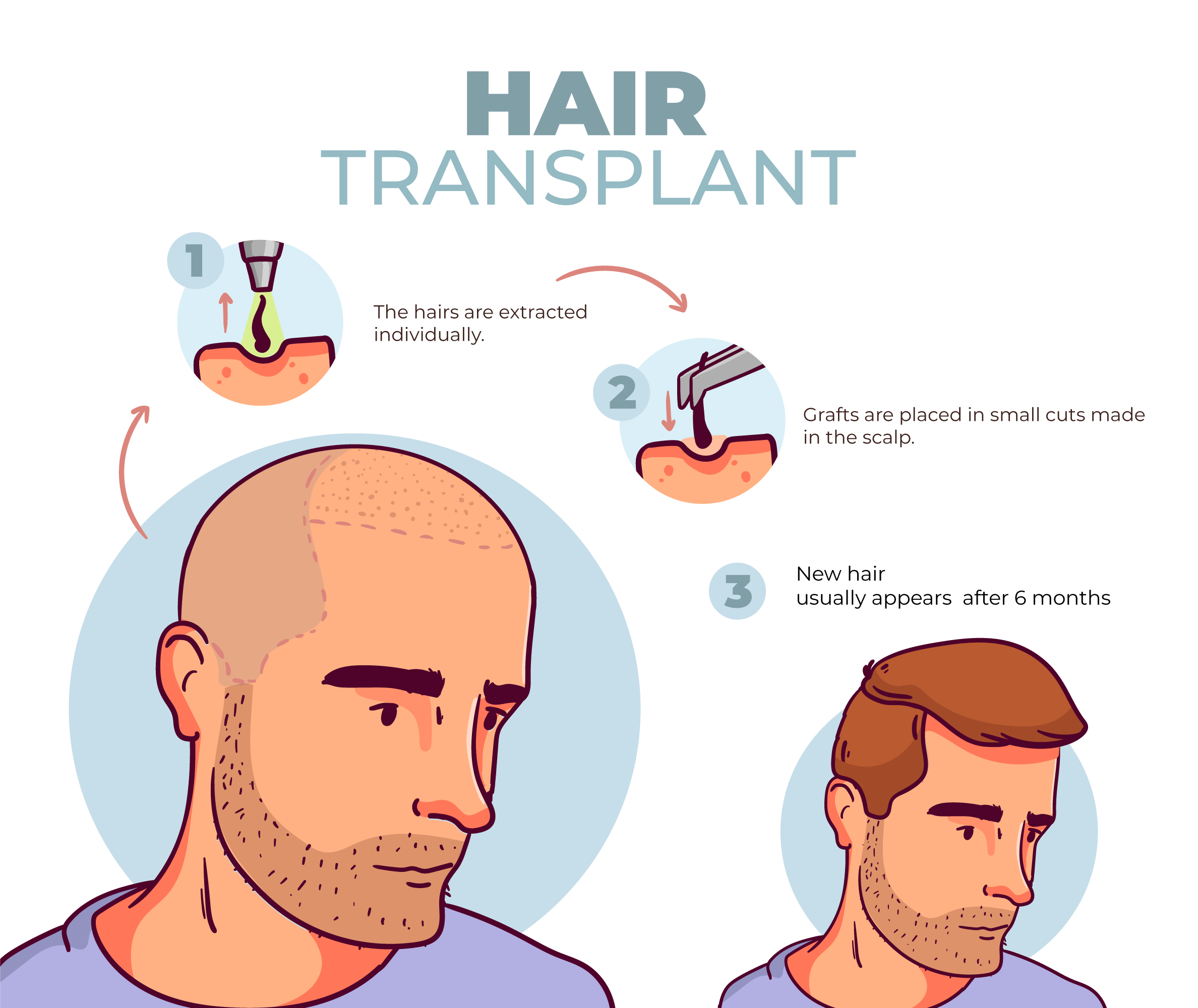 Benefits of Choosing the Interlocking FUE Technique for Hair Transplant