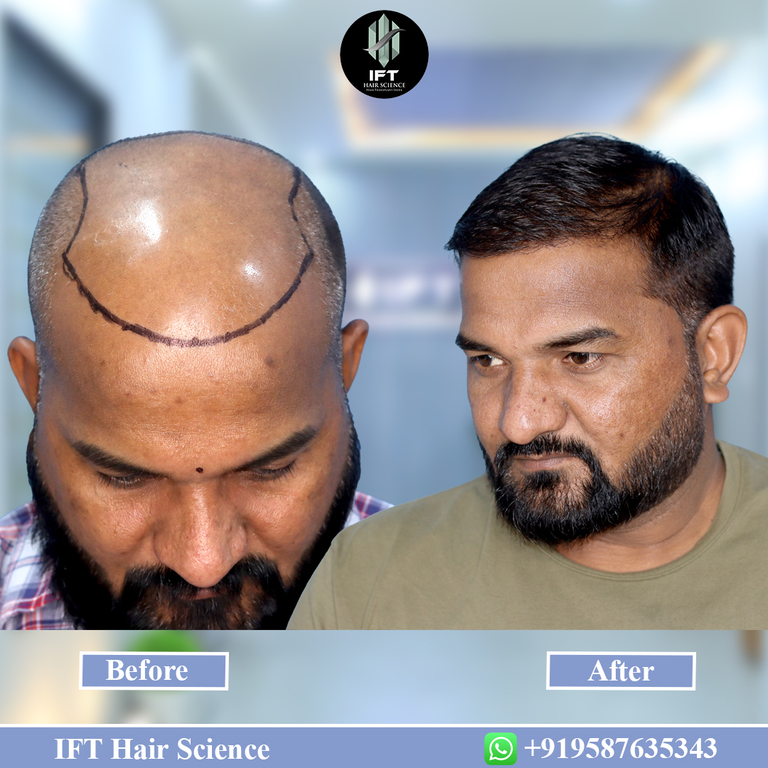 What to Expect During Your First Hair Transplant Consultation