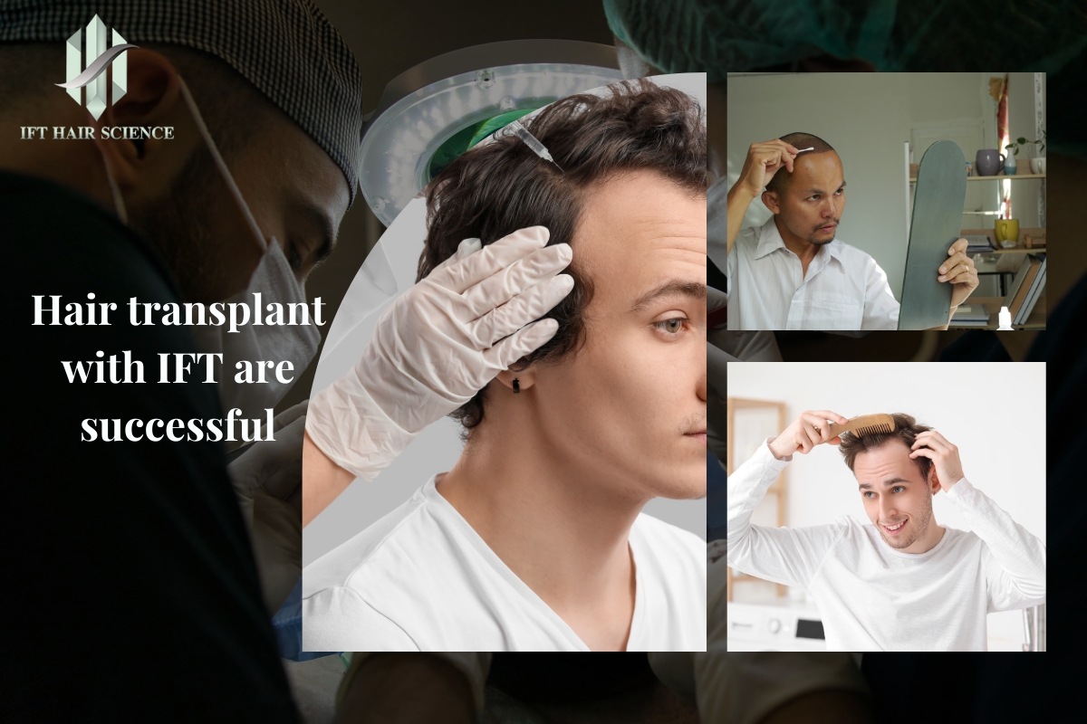 Hair transplant with IFT are successful