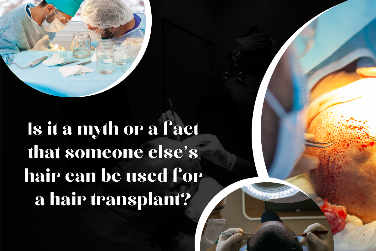 Debunking Myths: Why Using Someone Else's Hair for Hair Transplants Is Infeasible and Unethical | IFT Hair Science Jaipur