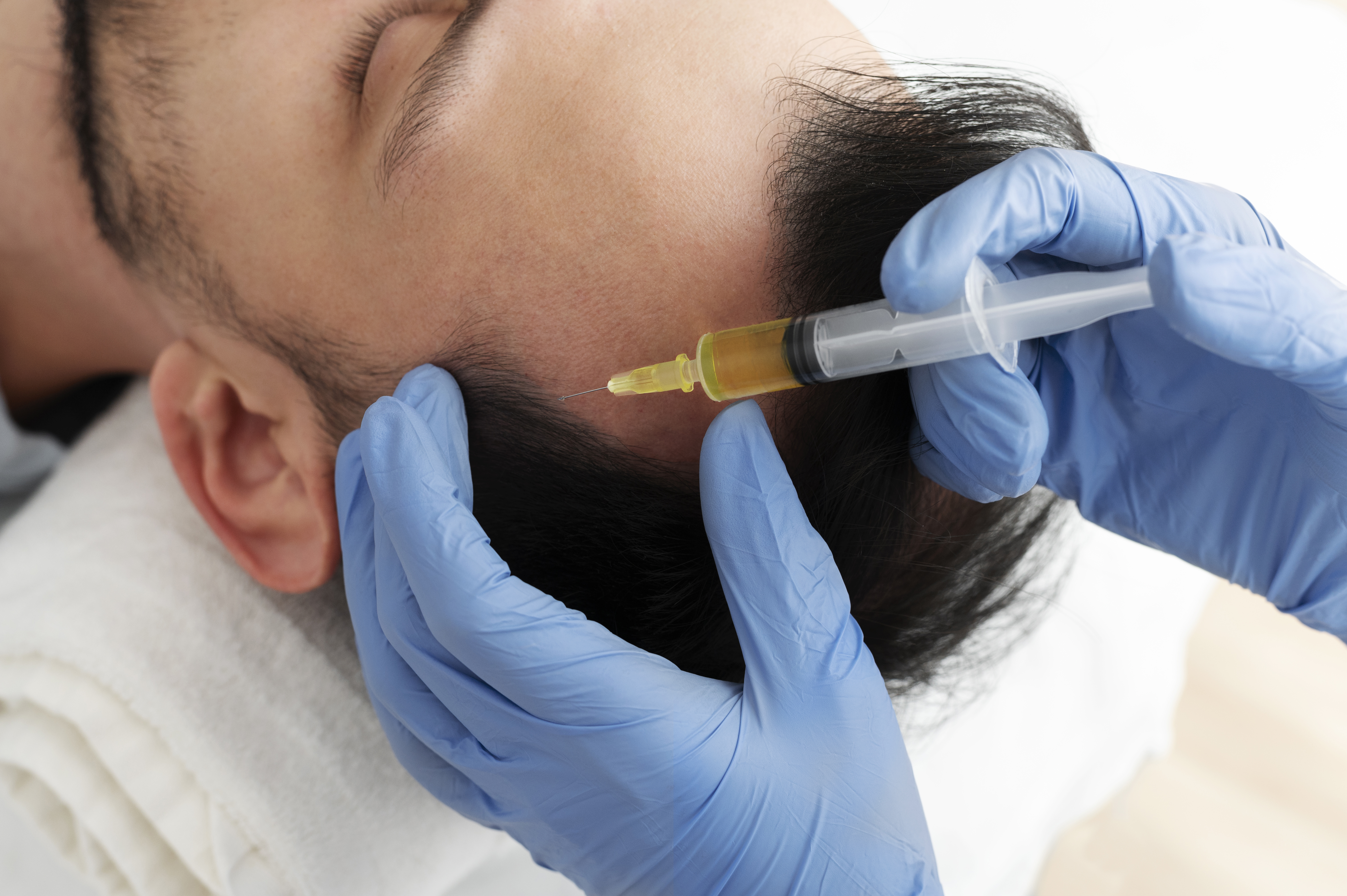 The Role of PRP Therapy in Hair Transplant Success