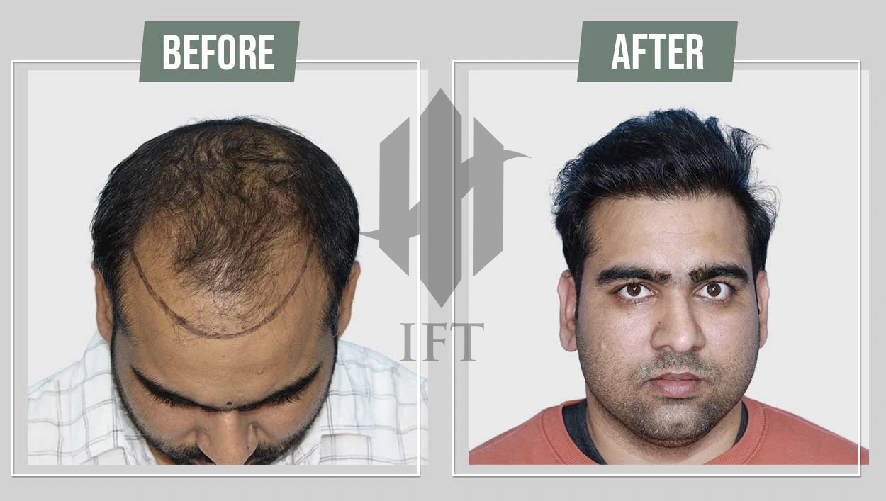 IFT Technique Result