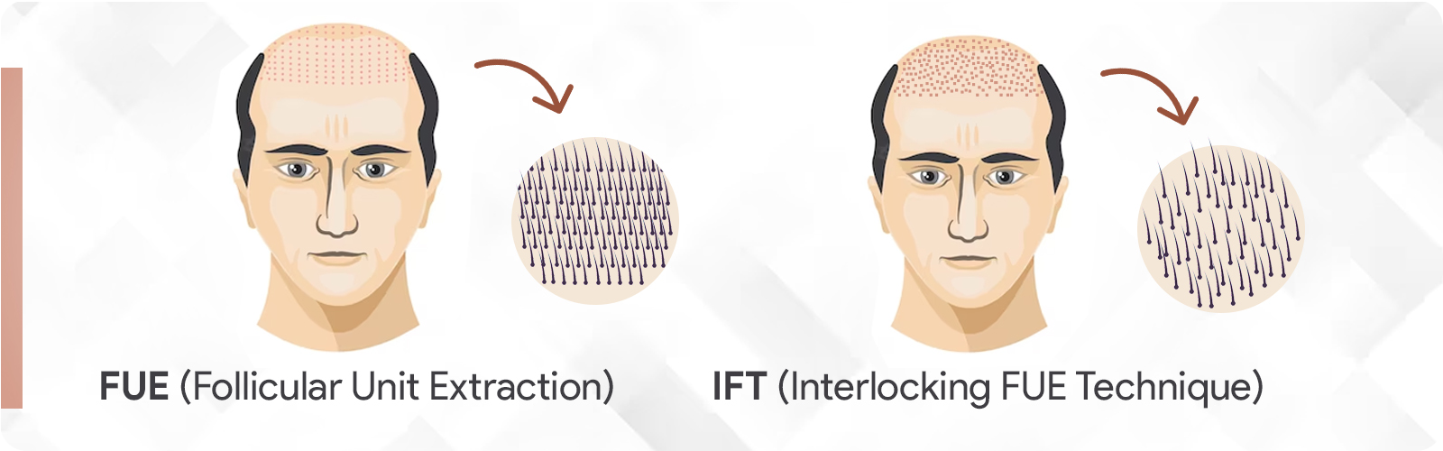 Interlocking Fue Technique