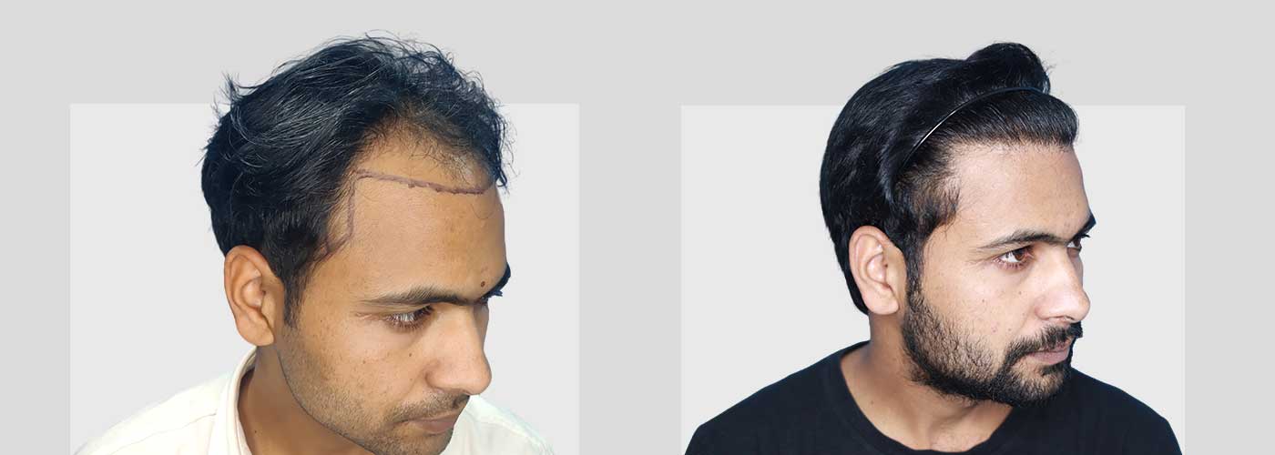 Hair Transplant For Men