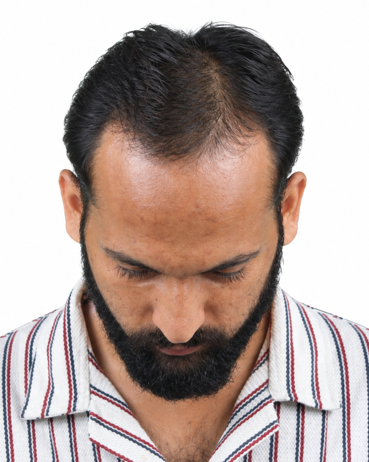 Hair Transplant Before