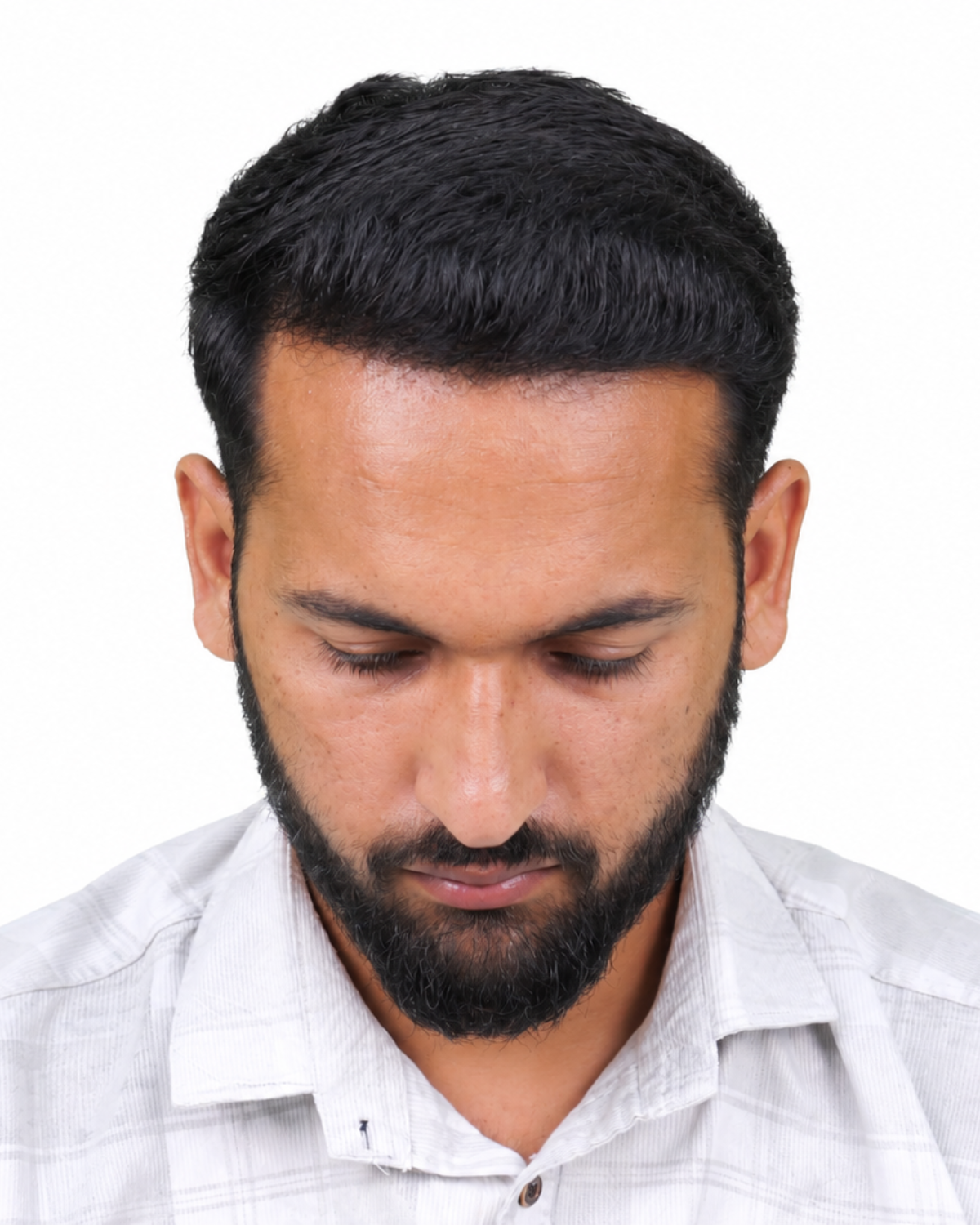 Hair Transplant After