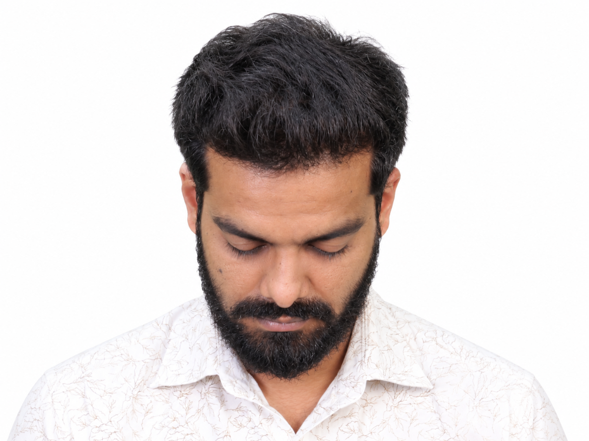 Hair transplant after result
