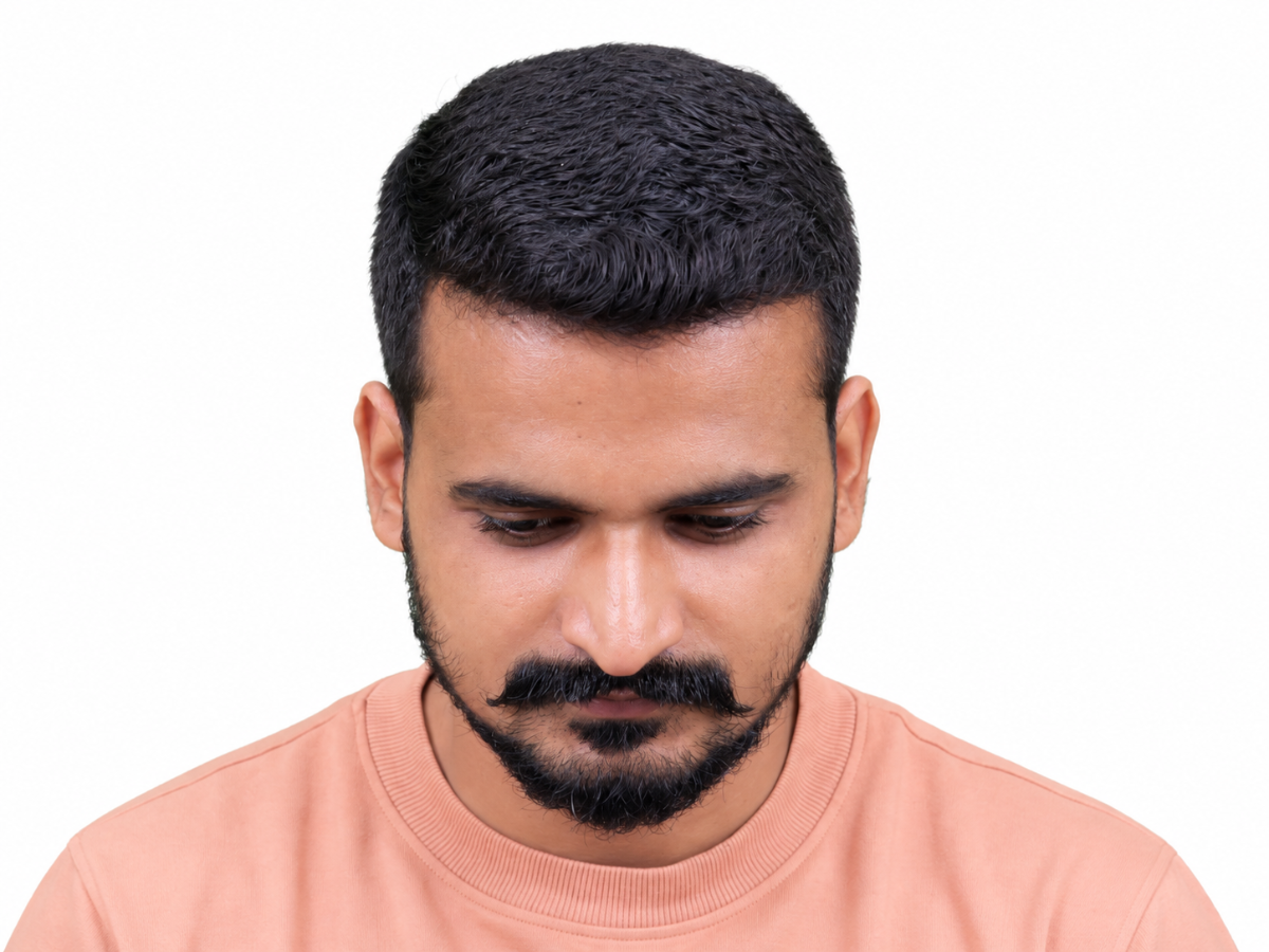 Hair transplant after result