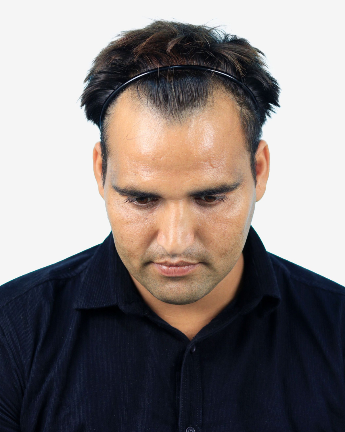 Hair Transplant Before