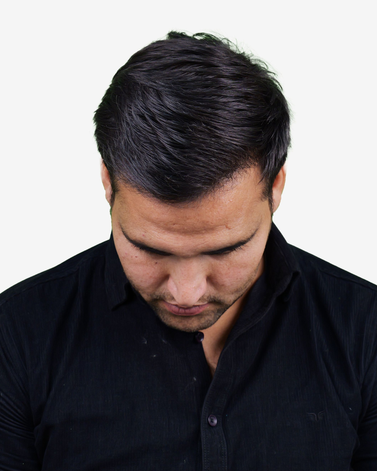 Hair Transplant After