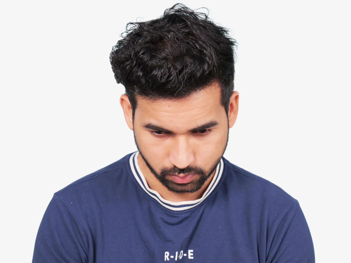 Hair transplant after result
