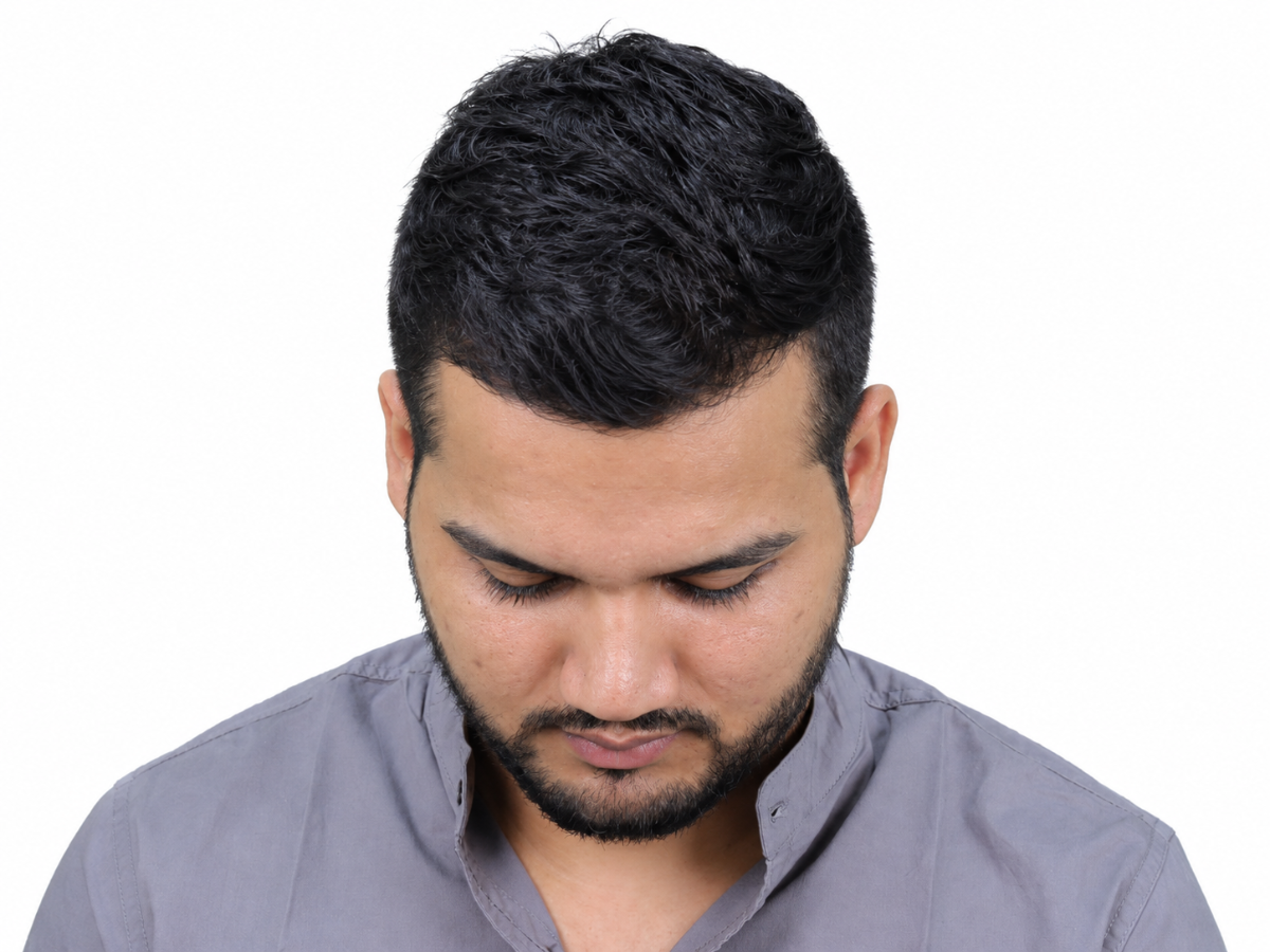 Hair transplant after result