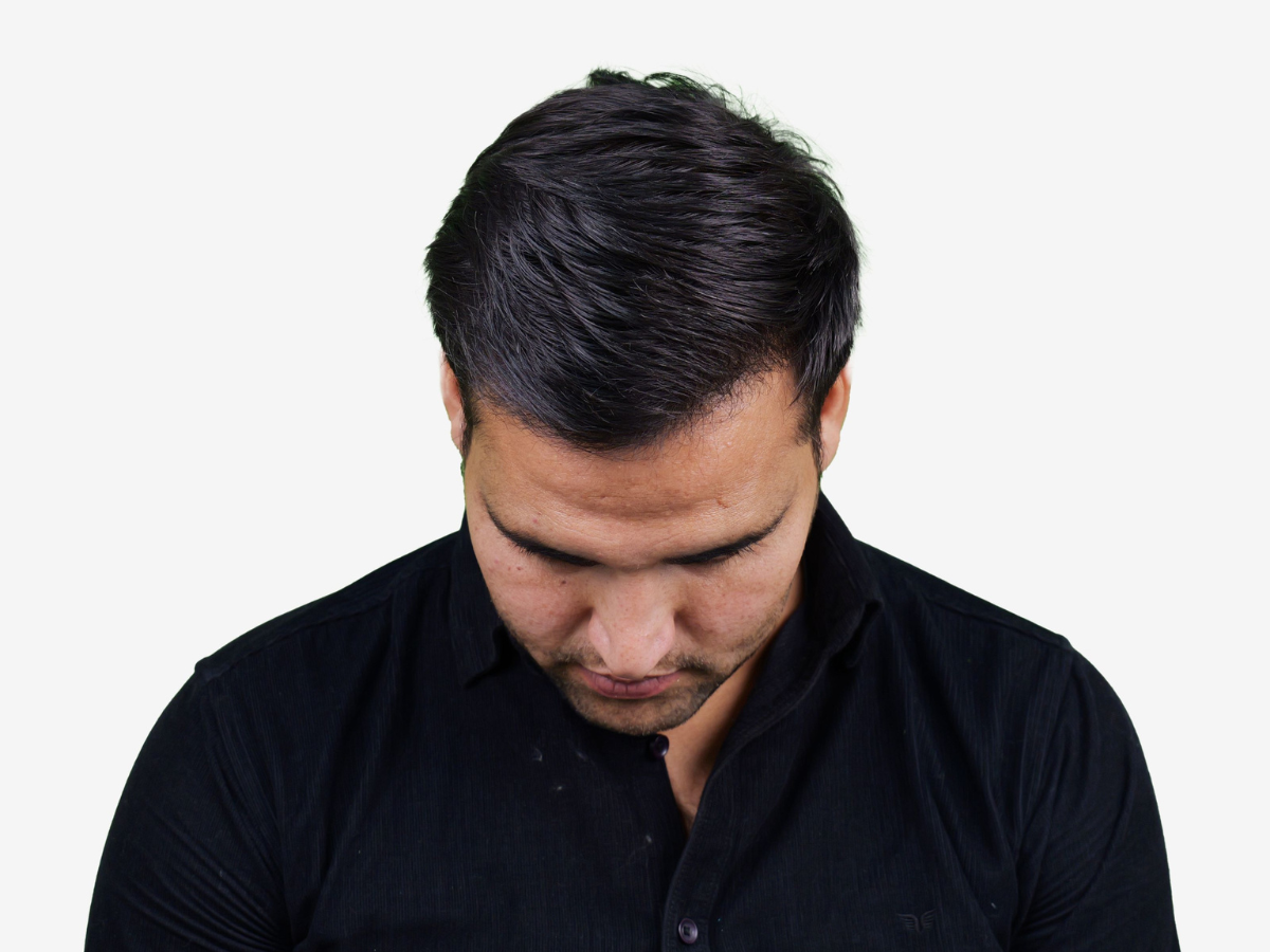 Hair transplant after result