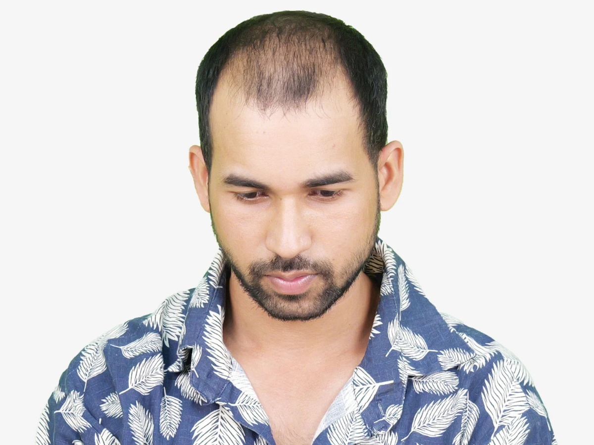 Hair transplant before result