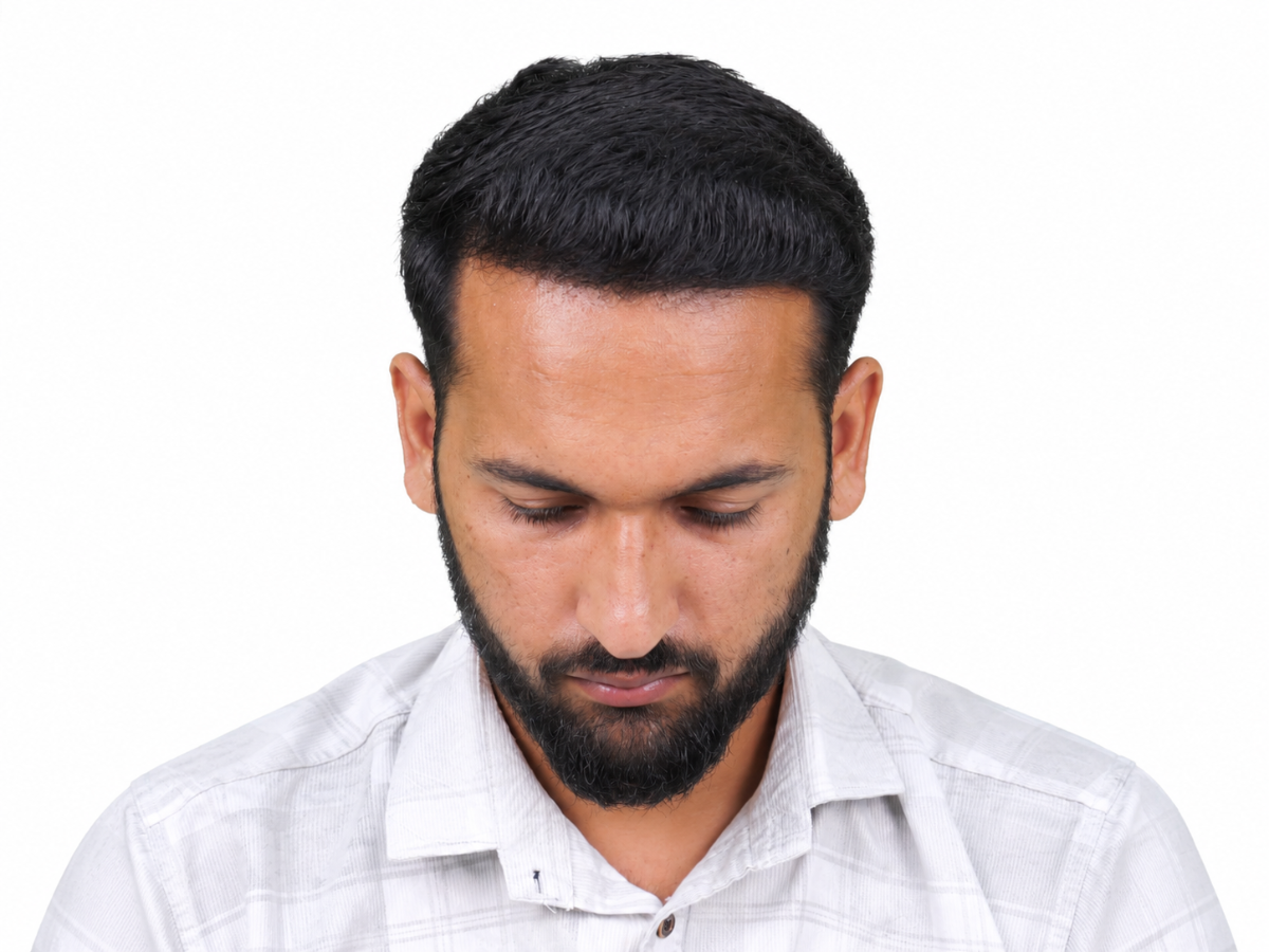 Hair transplant after result