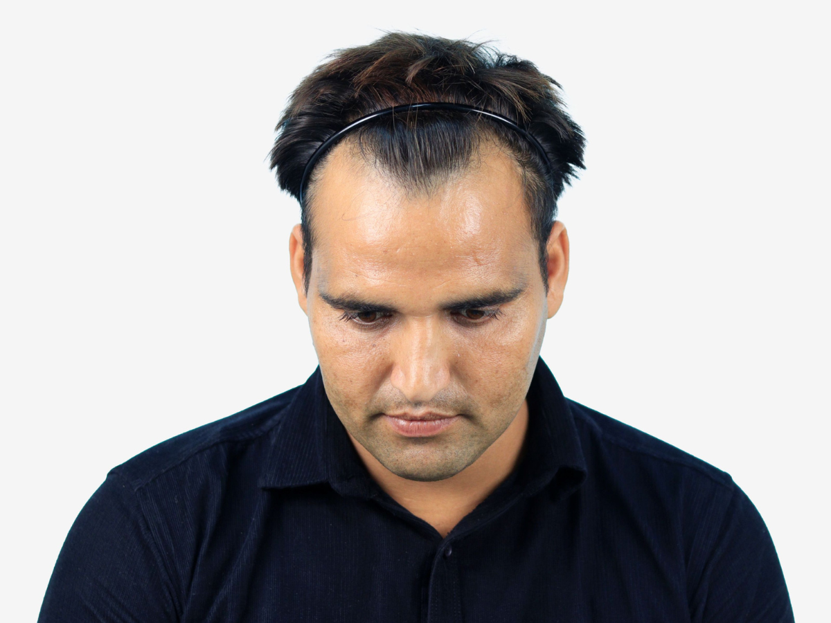 Hair transplant before result