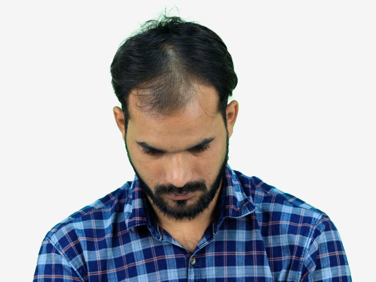 Hair transplant before result