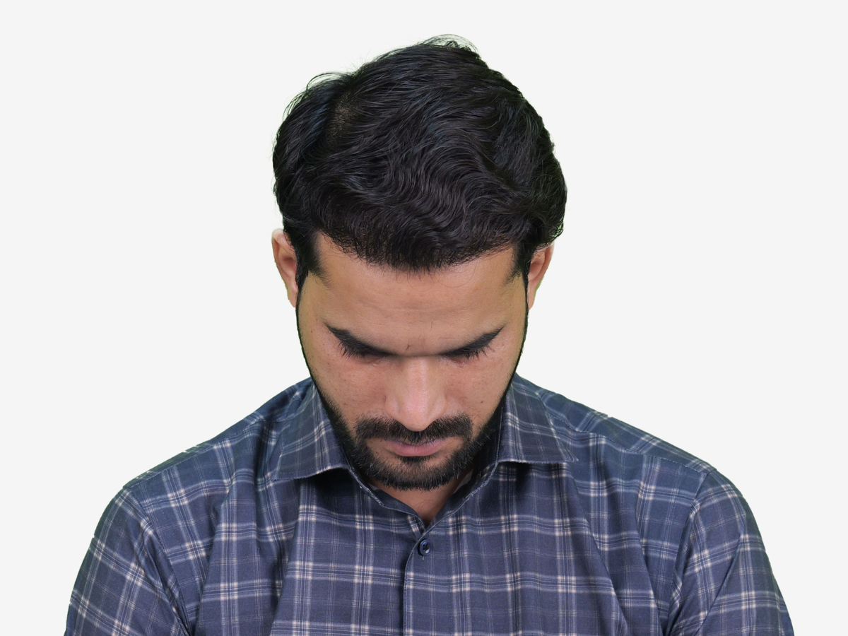 Hair transplant after result