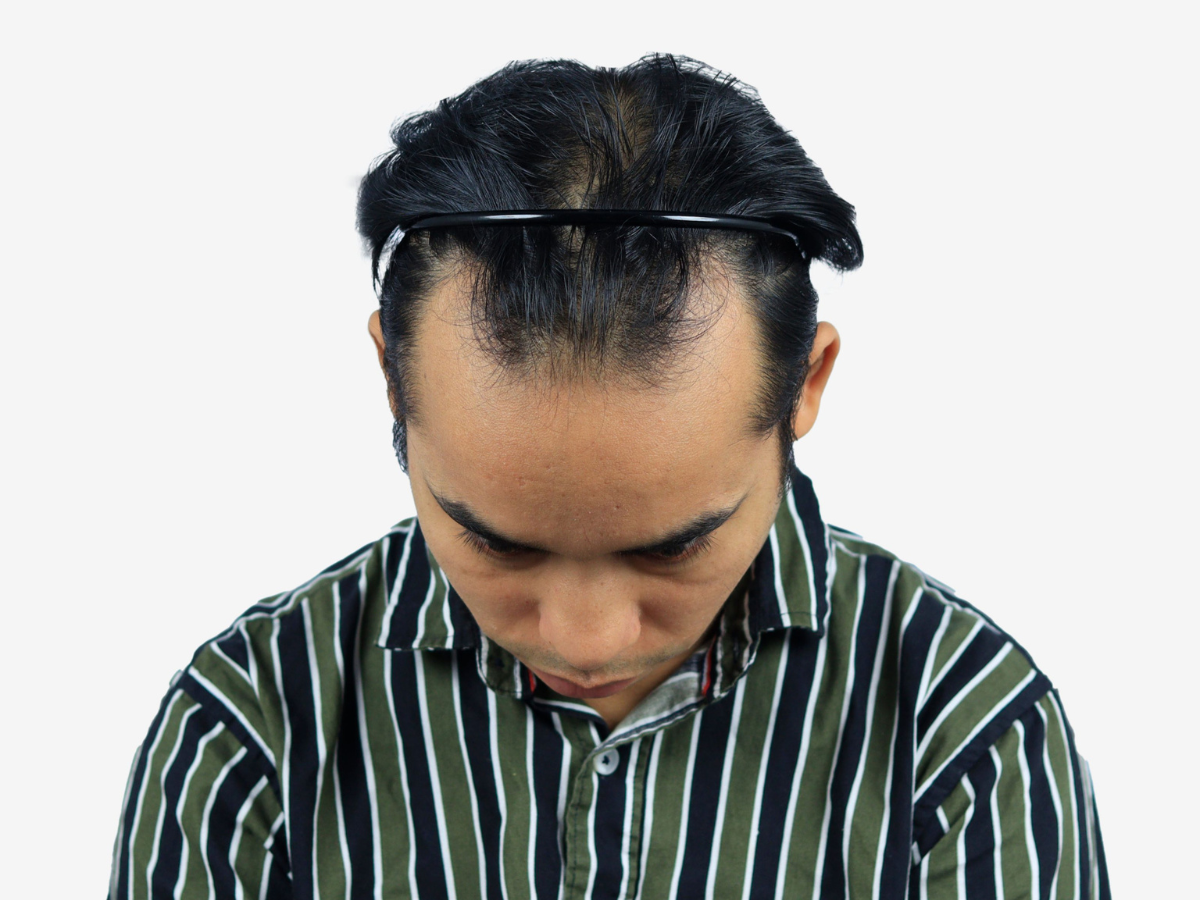 Hair transplant before result