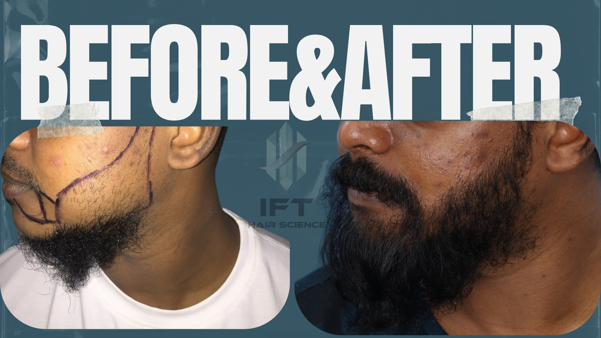 beard transplant in india , ift clinic beard transplant in india , ift clinic