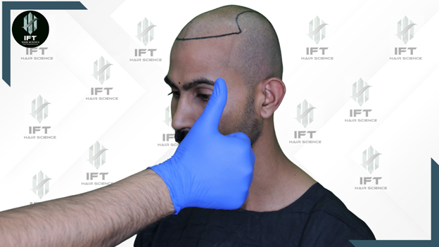 beard transplant in india , ift clinic 