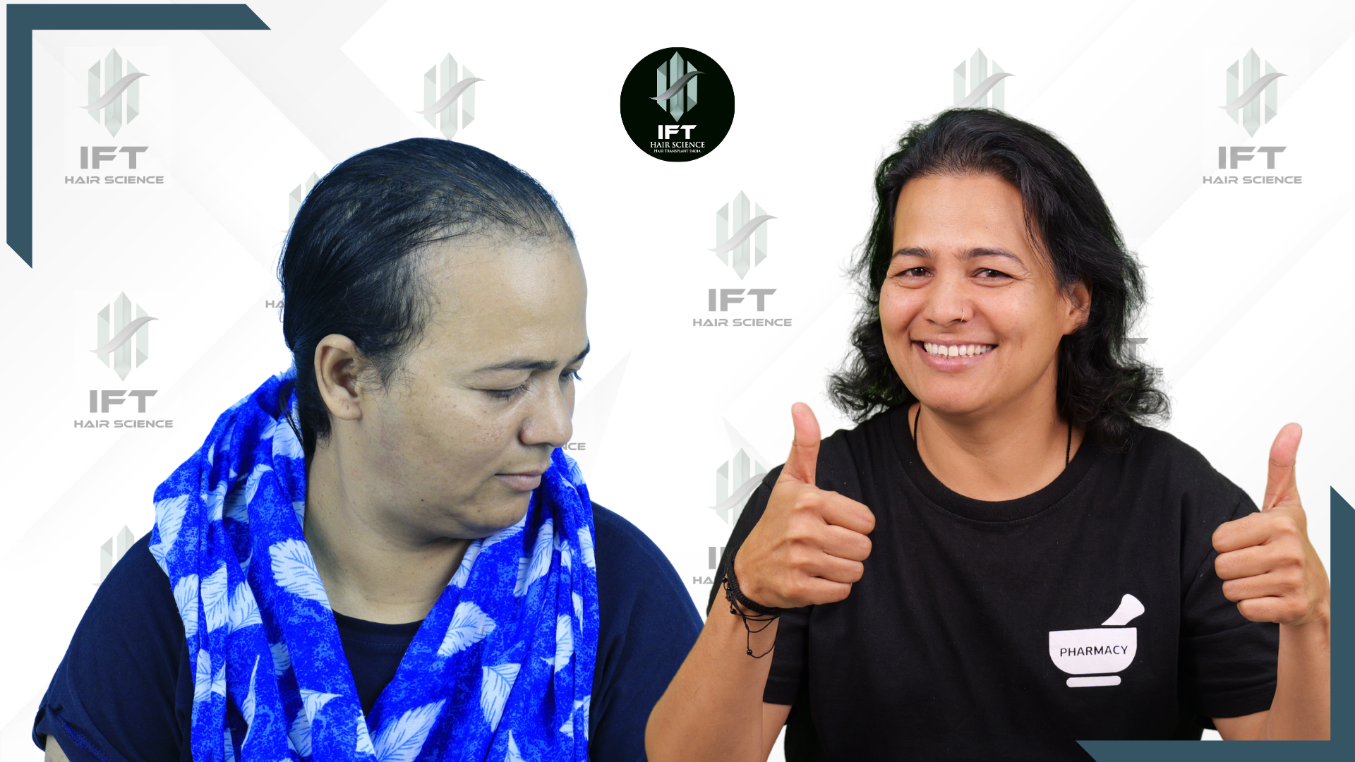 female hair transplant in india - ift clinic female hair transplant in india - ift clinic