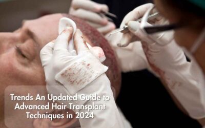 Trends An Updated Guide to Advanced Hair Transplant Techniques in 2024