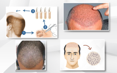 Innovation in Action: The Interlocking FUE Technique at IFT Hair Science