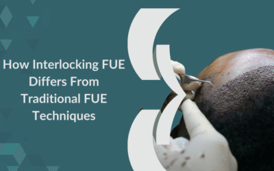 How Interlocking FUE Differs From Traditional FUE Techniques