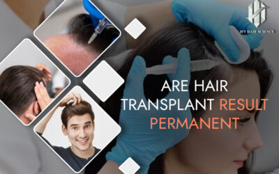 Are hair transplant results permanent