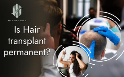 Is hair transplant permanent