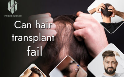 Causes Of Hair Transplant