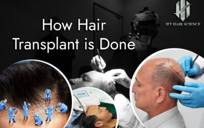 How Hair transplant is done