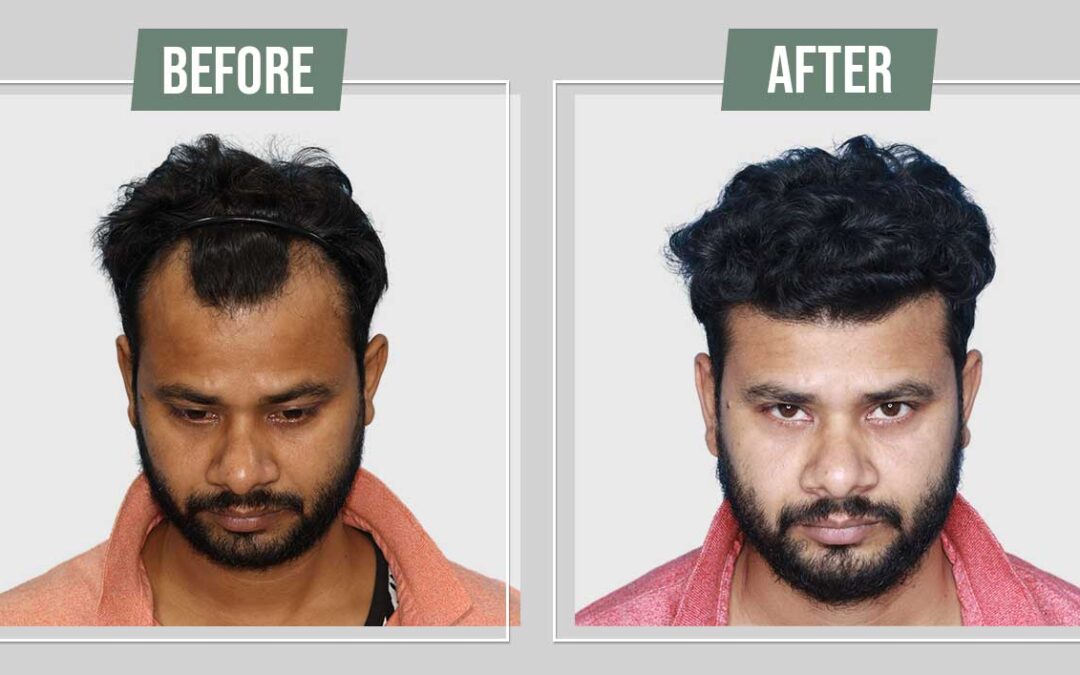 Understanding the Long-Term Benefits of Hair Transplants