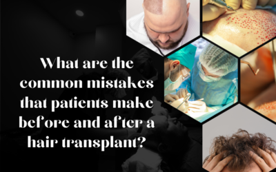 What Are The Common Mistakes That Patients Make Before And After A Hair Transplant