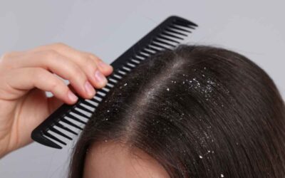 Preventing Hair Loss Caused by Dandruff: Expert Diagnosis and Treatment Strategies With IFT Hair Science